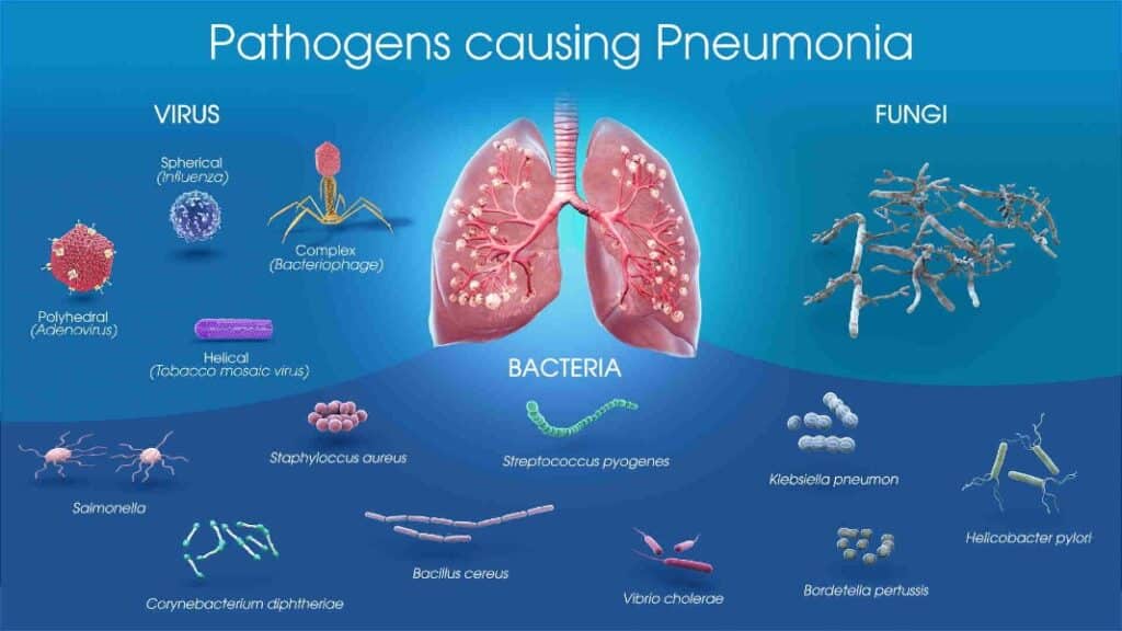 Image describing the different pathogens causing Pneumonia.