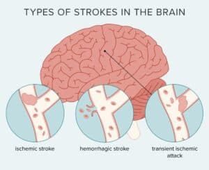Types of Strokes