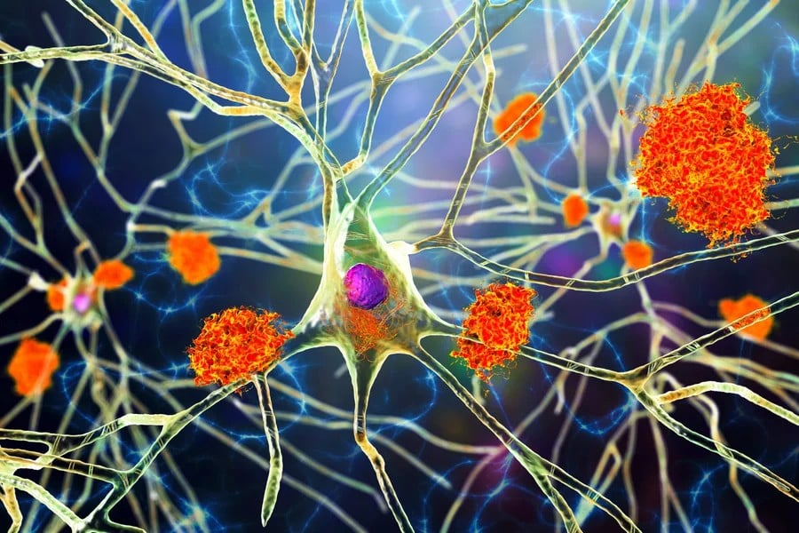 In Alzheimer’s disease, a protein fragment called beta-amyloid starts to accumulate between neurons, forming sticky clumps known as plaques.