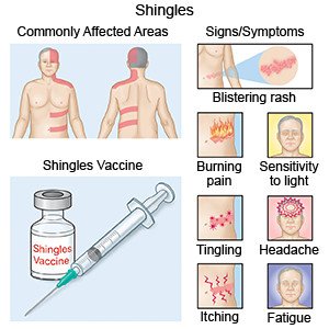 Symptoms of shingles